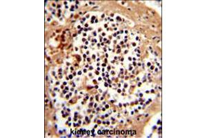 Formalin-fixed and paraffin-embedded human kidney carcinoma reacted with SERPINB7 Antibody , which was peroxidase-conjugated to the secondary antibody, followed by DAB staining. (SERPINB7 Antikörper  (AA 108-137))