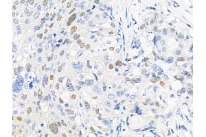 Phospho-KDM3A (Tyr1114) Antibody at 1/100 staining Human ovarian cancer by IHC-P. (KDM3A Antikörper  (pTyr1114))