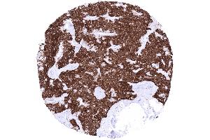 Thyroid Medullary carcinoma with strong cytoplasmic synaptophysin immunostaining of all tumor cells (Rekombinanter Synaptophysin Antikörper  (AA 274-313))