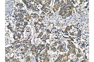 ABIN6256898 and ABIN6274828 at 1/100 staining human colorectal cancer by IHC-P.