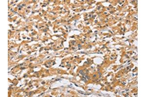 The image on the left is immunohistochemistry of paraffin-embedded Human thyroid cancer tissue using ABIN7128517(ARL8A Antibody) at dilution 1/20, on the right is treated with fusion protein. (ARL8A Antikörper)