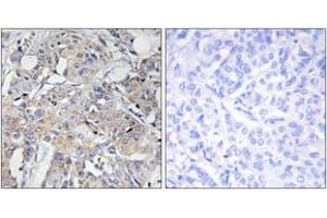 Immunohistochemistry analysis of paraffin-embedded human breast carcinoma tissue, using Collagen VI alpha3 Antibody. (COL6a3 Antikörper  (AA 2261-2310))