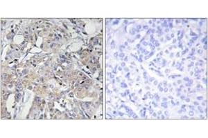 Immunohistochemistry analysis of paraffin-embedded human breast carcinoma tissue, using Collagen VI alpha3 Antibody.