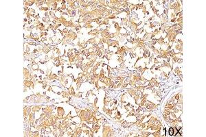 IHC staining of human melanoma (10X) with gp100 antibody (HMB45). (Melanoma gp100 Antikörper)