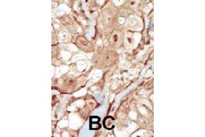 Formalin-fixed and paraffin-embedded human cancer tissue reacted with PDGFRB polyclonal antibody  , which was peroxidase-conjugated to the secondary antibody, followed by AEC staining. (PDGFRB Antikörper  (N-Term))