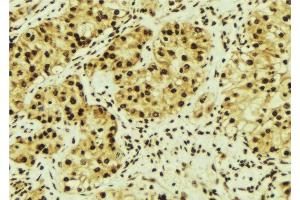 ABIN6276504 at 1/100 staining Human breast cancer tissue by IHC-P. (MAGED1 Antikörper  (Internal Region))