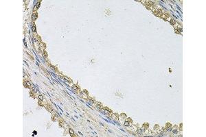Immunohistochemistry of paraffin-embedded Human prostate using MTERFD1 Polyclonal Antibody at dilution of 1:100 (40x lens). (MTERFD1 Antikörper)
