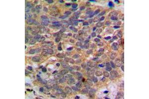 Immunohistochemical analysis of AKT (pS473) staining in human breast cancer formalin fixed paraffin embedded tissue section. (AKT1 Antikörper  (C-Term, pSer473))
