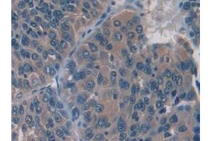 Detection of IL12A in Human Liver cancer Tissue using Monoclonal Antibody to Interleukin 12A (IL12A) (IL12A Antikörper  (AA 23-219))