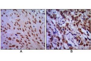 Immunohistochemical analysis of paraffin-embedded human lung cancer (A) and esophageal cancer (B), showing cytoplasmic localization using CDC2 antibody with DAB staining. (CDK1 Antikörper)