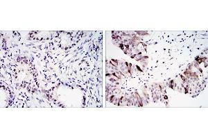 Immunohistochemical analysis of paraffin-embedded lung cancer (left) and ovary tumour tissues (right) using CCNB1 mouse mAb with DAB staining. (Cyclin B1 Antikörper)