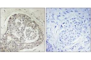 Immunohistochemistry analysis of paraffin-embedded human breast carcinoma, using K0100 Antibody. (KIAA0100/BCOX1 Antikörper  (AA 681-730))
