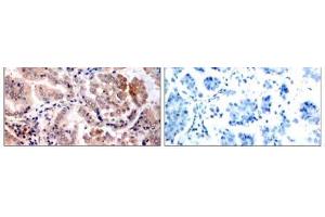 Immunohistochemical analysis of paraffin-embedded human lung carcinoma tissue, using AMPK1 (Ab-174) antibody (E021191). (PRKAA1 Antikörper)