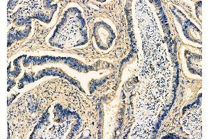ABIN6261337 and ABIN6277871 at 1/100 staining Human prostate cancer by IHC-P.