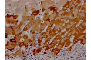 IHC image of ABIN7127603 diluted at 1:100 and staining in paraffin-embedded human liver cancer performed on a Leica BondTM system. (Rekombinanter LRG1 Antikörper)