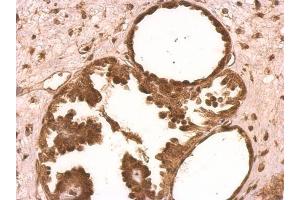 IHC-P Image XLF antibody [N3C3] detects XLF protein on human ovarian carcinoma by immunohistochemical analysis. (NHEJ1 Antikörper)