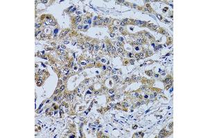 Immunohistochemistry of paraffin-embedded human colon carcinoma using TPPP3 antibody (ABIN2560511) at dilution of 1:100 (40x lens). (TPPP3 Antikörper)