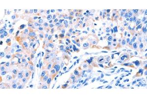 Immunohistochemistry of paraffin-embedded Human lung cancer tissue using SMG8 Polyclonal Antibody at dilution 1:50 (SMG8 Antikörper)