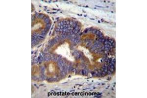 Formalin fixed, paraffin embedded human prostate carcinoma stained with YI016 Antibody (C-term) followed by peroxidase conjugation of the secondary antibody and DAB staining. (YI016 (AA 260-288), (C-Term) Antikörper)