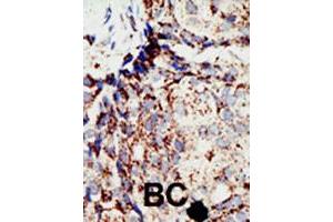 Formalin-fixed and paraffin-embedded human cancer tissue reacted with BAP1 polyclonal antibody  , which was peroxidase-conjugated to the secondary antibody, followed by DAB staining. (BAP1 Antikörper  (N-Term))