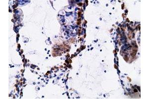 Immunohistochemical staining of paraffin-embedded Adenocarcinoma of Human breast tissue using anti-EPHX2 mouse monoclonal antibody. (EPHX2 Antikörper)