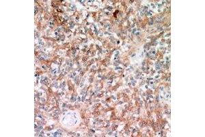 Immunohistochemical analysis of TRP2 staining in human breast cancer formalin fixed paraffin embedded tissue section.