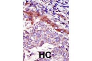 Formalin-fixed and paraffin-embedded human cancer tissue reacted with the primary antibody, which was peroxidase-conjugated to the secondary antibody, followed by AEC staining. (HUNK Antikörper  (C-Term))