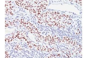 Formalin-fixed, paraffin-embedded human bladder carcinoma stained with p57 antibody (57P06). (CDKN1C Antikörper)