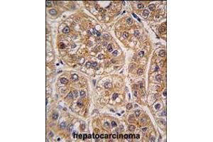 Formalin-fixed and paraffin-embedded human hepatocarcinoma tissue reacted with AKR1A1 antibody , which was peroxidase-conjugated to the secondary antibody, followed by DAB staining. (AKR1A1 Antikörper  (C-Term))