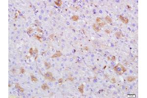 Paraformaldehyde-fixed, paraffin embedded human hepatocellular carcinoma, Antigen retrieval by boiling in sodium citrate buffer (pH6) for 15min, Block endogenous peroxidase by 3% hydrogen peroxide for 30 minutes, Blocking buffer (normal goat serum) at 37°C for 20min, Antibody incubation with Serum albumin (3F4) Monoclonal Antibody, Unconjugated (bsm-0945M) at 1:500 overnight at 4°C, followed by a conjugated secondary and DAB staining. (Albumin Antikörper)