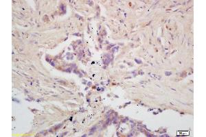 Formalin-fixed and paraffin embedded human colon carcinoma labeled with Rabbit Anti GPAM Polyclonal Antibody, Unconjugated (ABIN709121) at 1:200 followed by conjugation to the secondary antibody and DAB staining (GPAM Antikörper  (AA 611-710))