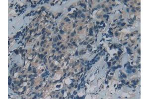 DAB staining on IHC-P; Samples: Human Thyroid cancer Tissue (GAS6 Antikörper  (AA 136-311))
