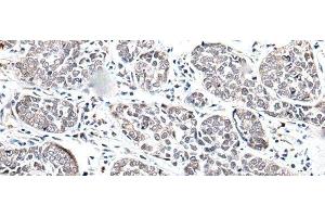 Immunohistochemistry of paraffin-embedded Human esophagus cancer tissue using BRMS1L Polyclonal Antibody at dilution of 1:45(x200) (BRMS1L Antikörper)