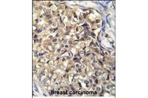 KLHL35 Antibody (C-term) (ABIN656072 and ABIN2845420) immunohistochemistry analysis in formalin fixed and paraffin embedded human breast carcinoma followed by peroxidase conjugation of the secondary antibody and DAB staining. (KLHL35 Antikörper  (C-Term))