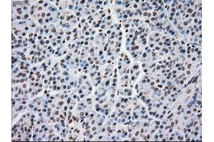 Immunohistochemical staining of paraffin-embedded Adenocarcinoma of breast tissue using anti-MRI1 mouse monoclonal antibody. (MRI1 Antikörper)