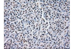 Immunohistochemical staining of paraffin-embedded Adenocarcinoma of breast tissue using anti-MRI1 mouse monoclonal antibody. (MRI1 Antikörper)