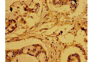 Immunohistochemistry of paraffin-embedded human pancreatic cancer using ABIN7168921 at dilution of 1:100 (HTRA2 Antikörper  (AA 334-458))
