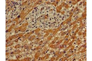 Immunohistochemistry of paraffin-embedded human liver cancer using ABIN7166683 at dilution of 1:100 (APOBEC4 Antikörper  (AA 221-367))
