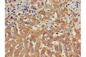 Immunohistochemistry of paraffin-embedded human liver cancer using ABIN7169681 at dilution of 1:100 (STAT4 Antikörper  (AA 569-748))