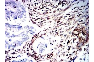 Immunohistochemical analysis of paraffin-embedded rectum cancer tissues using VIM mouse mAb with DAB staining. (Vimentin Antikörper  (AA 2-466))