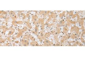 Immunohistochemistry of paraffin-embedded Human liver cancer tissue using DHRSX Polyclonal Antibody at dilution of 1:30(x200) (DHRSX Antikörper)