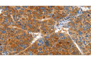 Immunohistochemistry of paraffin-embedded Human liver cancer using VWA5A Polyclonal Antibody at dilution of 1:60 (VWA5A Antikörper)
