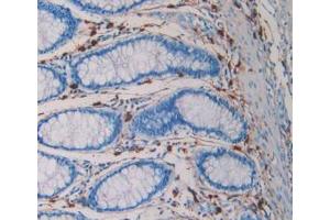 DAB staining on IHC-P; Samples: Human Rectum Cancer Tissue (TPSAB1 Antikörper  (AA 161-262))