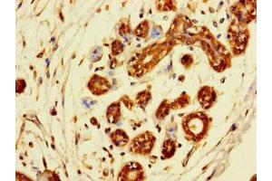 Immunohistochemistry of paraffin-embedded human breast cancer using ABIN7171277 at dilution of 1:100 (SDCBP2 Antikörper  (AA 11-207))