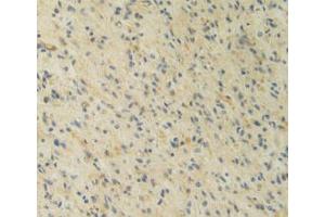 IHC-P analysis of Human Glioma Tissue, with DAB staining. (IL12A Antikörper  (AA 23-219))