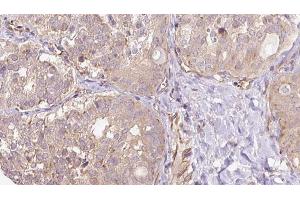 ABIN6273317 at 1/100 staining Human thyroid cancer tissue by IHC-P. (SGCG Antikörper  (C-Term))