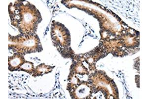 The image on the left is immunohistochemistry of paraffin-embedded Human tonsil tissue using ABIN7193115(ZNF473 Antibody) at dilution 1/30, on the right is treated with synthetic peptide.