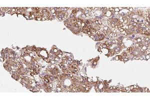 ABIN6272348 at 1/100 staining Human liver cancer tissue by IHC-P. (CDC42BPB Antikörper  (C-Term))