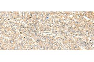 Immunohistochemistry of paraffin-embedded Human liver cancer tissue using WDFY4 Polyclonal Antibody at dilution of 1:50(x200) (WDFY4 Antikörper)