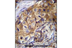 CTAGE5 Antibody (C-term) (ABIN656676 and ABIN2845915) immunohistochemistry analysis in formalin fixed and paraffin embedded human breast carcinoma followed by peroxidase conjugation of the secondary antibody and DAB staining. (MIA2 Antikörper  (C-Term))